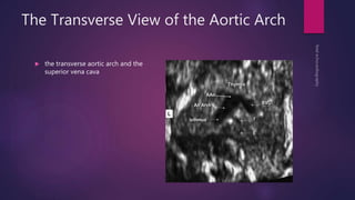 The Transverse View of the Aortic Arch
 the transverse aortic arch and the
superior vena cava
 