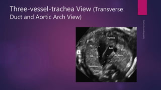 Three-vessel-trachea View (Transverse
Duct and Aortic Arch View)
 