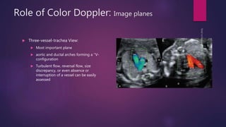 Role of Color Doppler: Image planes
 Three-vessel-trachea View:
 Most important plane
 aortic and ductal arches forming a ‘‘V-
configuration
 Turbulent flow, reversal flow, size
discrepancy, or even absence or
interruption of a vessel can be easily
assessed
 