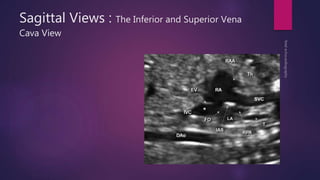 Sagittal Views : The Inferior and Superior Vena
Cava View
 