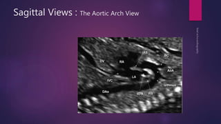 Sagittal Views : The Aortic Arch View
 