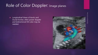 Role of Color Doppler: Image planes
 Longitudinal Views of Aortic and
Ductal Arches: often power doppler
and bidirectional HD color may be
needed.
 