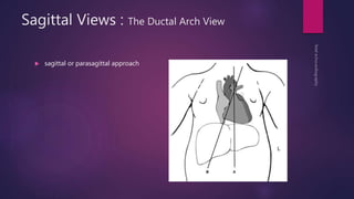 Sagittal Views : The Ductal Arch View
 sagittal or parasagittal approach
 