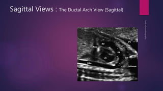 Sagittal Views : The Ductal Arch View (Sagittal)
 