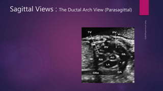 Sagittal Views : The Ductal Arch View (Parasagittal)
 