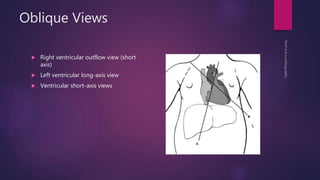Oblique Views
 Right ventricular outflow view (short
axis)
 Left ventricular long-axis view
 Ventricular short-axis views
 