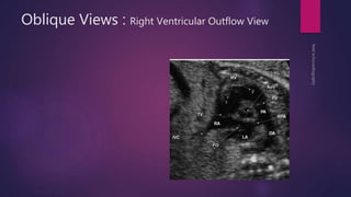 Oblique Views : Right Ventricular Outflow View
 