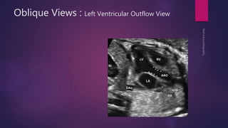 Oblique Views : Left Ventricular Outflow View
 