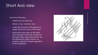 Short Axis view
Scanning Technique
1. Determine the fetal situs
2. Obtain a four-chamber-view
3. rotate the transducer 90 degrees to
obtain short-axis views of the heart
4. Serial short-axis views of the heart,
from the apex of the left ventricle to
the pulmonary artery bifurcation, can
be obtained by slight anterior-to-
posterior (apical-to-basal) angulation
of the transducer
 
