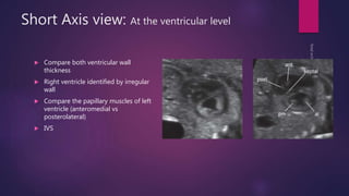 Short Axis view: At the ventricular level
 Compare both ventricular wall
thickness
 Right ventricle identified by irregular
wall
 Compare the papillary muscles of left
ventricle (anteromedial vs
posterolateral)
 IVS
 