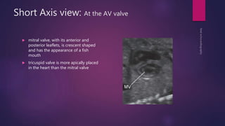Short Axis view: At the AV valve
 mitral valve, with its anterior and
posterior leaflets, is crescent shaped
and has the appearance of a fish
mouth
 tricuspid valve is more apically placed
in the heart than the mitral valve
 