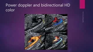 Power doppler and bidirectional HD
color
 