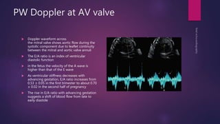 PW Doppler at AV valve
 Doppler waveform across
the mitral valve shows aortic flow during the
systolic component due to leaflet continuity
between the mitral and aortic valve annuli
 The E/A ratio is an index of ventricular
diastolic function
 in the fetus the velocity of the A wave is
higher than that of the E wave
 As ventricular stiffness decreases with
advancing gestation, E/A ratio increases from
0.53 ± 0.05 in the first trimester to about 0.70
± 0.02 in the second half of pregnancy
 The rise in E/A ratio with advancing gestation
suggests a shift of blood flow from late to
early diastole
 