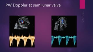 PW Doppler at semilunar valve
 