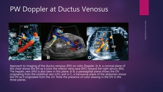 PW Doppler at Ductus Venosus
Approach to imaging of the ductus venosus (DV) on color Doppler. In A, a coronal plane of
the chest shows the DV as it joins the inferior vena cava (IVC) toward the right atrium (RA).
The hepatic vein (HV) is also seen in this plane. In B, a parasagittal plane shows the DV
originating from the umbilical vein (UV), and in C, a transverse plane of the abdomen shows
the DV as it originated from the UV. Note the presence of color aliasing in the DV in the
three planes.
 