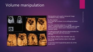 Volume manipulation
Manipulation of a spatio-temporal image
correlation (STIC) volume.
A: The original
STIC data set is shown in an orthogonal plane
display.
The four-chamber plane as a ‘‘single
plane’’ is demonstrated in systole (B) with closed
atrioventricular valves and in diastole (C) with
opened valves.
Scrolling through the volume demonstrates the
upper abdomen with the stomach
(ST) (D),
the slightly oblique five-chamber view (E),
the three-vessel-trachea view in the upper
thorax (F)
a reconstructed longitudinal plane (G) of the
aortic arch.
 