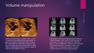Volume manipulation
Spatio-temporal image correlation (STIC) volume
in a fetus with an atrioventricular septal defect. In
plane A, the defect is not clearly demonstrated as
the valve leaflets are closed. By scrolling through
the cursor (open arrow), the interventricular septal
defect is clearly demonstrated (asterisk) in plane B
when the valve leaflets are open.
Tomographic ultrasound imaging of spatio-temporal
image correlation (STIC) volume of the fetal heart in
gray scale. In the upper left image, the orientation
plane A is seen (highlighted in yellow) with the parallel
vertical lines referring to the planes shown in the
display (-4 to +4). Interplane distance and total
number of planes are chosen by the examiner
 
