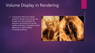 Volume Display in Rendering
 Transparent Minimum Mode:
anatomic details of structures are
limited, but the projection of
anechoic structures such as the
cardiac chambers and great vessels
allows for a useful display
of cardiac anatomy.
 