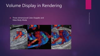 Volume Display in Rendering
 Three-dimensional Color Doppler and
Glass Body Mode
 