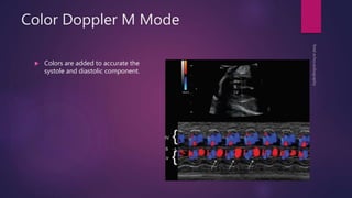 Color Doppler M Mode
 Colors are added to accurate the
systole and diastolic component.
 