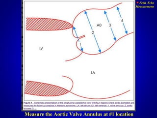 Fetal echo measurments | PPTX