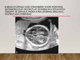 Ultrasound to evaluate Fetal face and neck. ASW.pptx