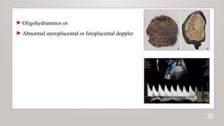 ►Oligohydramnios or
►Abnormal uteroplacental or fetoplacental doppler
20
 