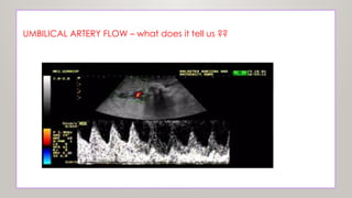 First sign of hypoxia & growth retardation
UMBILICAL ARTERY FLOW – what does it tell us ??
 