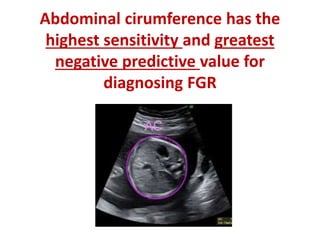 Abdominal cirumference has the
highest sensitivity and greatest
negative predictive value for
diagnosing FGR
 