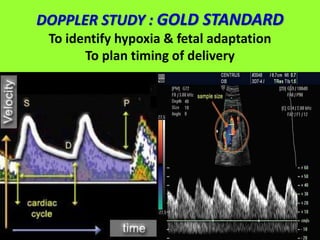 DOPPLER STUDY : GOLD STANDARD
To identify hypoxia & fetal adaptation
To plan timing of delivery
 