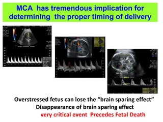 Overstressed fetus can lose the “brain sparing effect”
Disappearance of brain sparing effect
very critical event Precedes Fetal Death
MCA has tremendous implication for
determining the proper timing of delivery
 