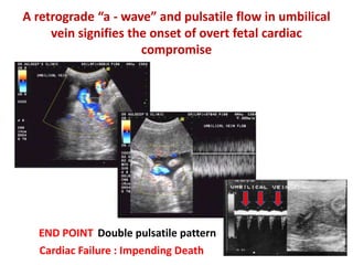 A retrograde “a - wave” and pulsatile flow in umbilical
vein signifies the onset of overt fetal cardiac
compromise
Double pulsatile patternEND POINT
Cardiac Failure : Impending Death
 