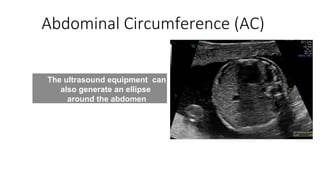 Comprehensive Guide to Fetal Growth Assessment and Management | PPT