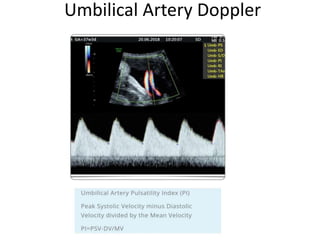 Umbilical Artery Doppler
 