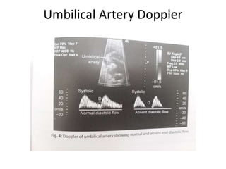 Umbilical Artery Doppler
 