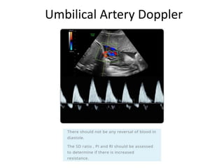Umbilical Artery Doppler
 