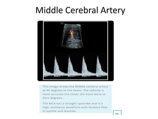 Middle Cerebral Artery
 