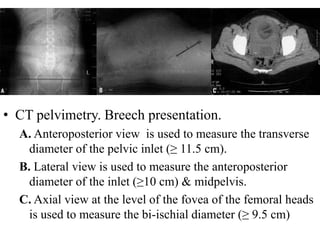 • CT pelvimetry. Breech presentation.
A. Anteroposterior view is used to measure the transverse
diameter of the pelvic inlet (≥ 11.5 cm).
B. Lateral view is used to measure the anteroposterior
diameter of the inlet (≥10 cm) & midpelvis.
C. Axial view at the level of the fovea of the femoral heads
is used to measure the bi-ischial diameter (≥ 9.5 cm)
 