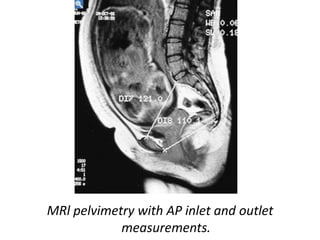 MRl pelvimetry with AP inlet and outlet
measurements.
 