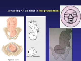 -presenting AP diameter in face presentations
 