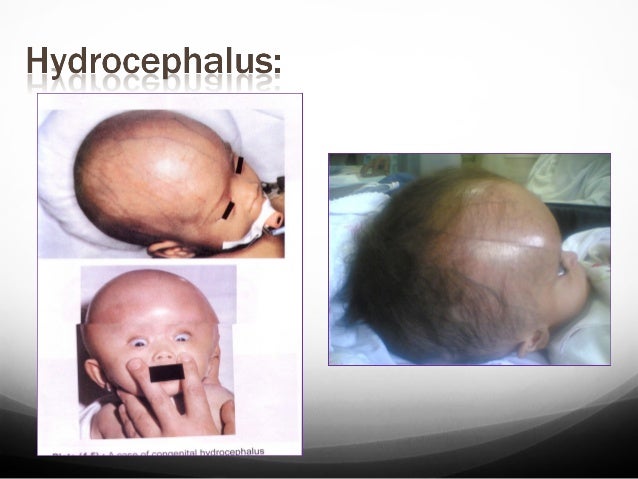 Fetal, infant and pediatric hydrocephalus medical report