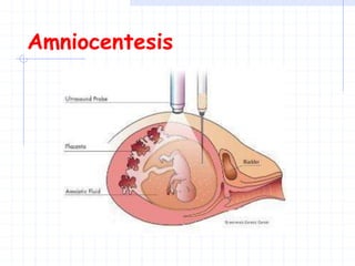 Amniocentesis
 