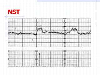 NST
 