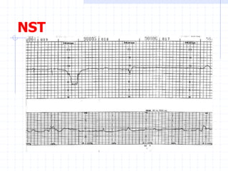 NST
 