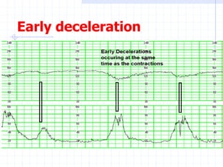 Early deceleration
 