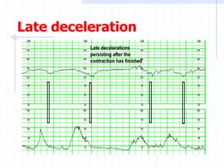 Late deceleration
 