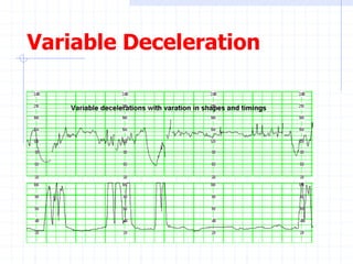 Variable Deceleration
 