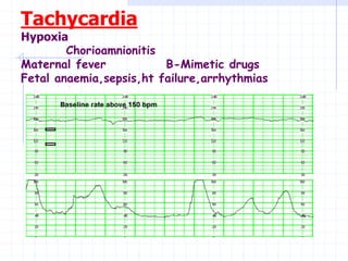 Tachycardia
Hypoxia
Chorioamnionitis
Maternal fever B-Mimetic drugs
Fetal anaemia,sepsis,ht failure,arrhythmias
 