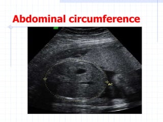 Abdominal circumference
 