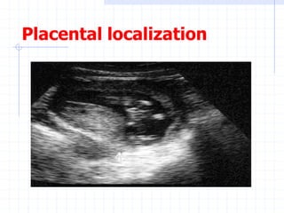 Placental localization
 